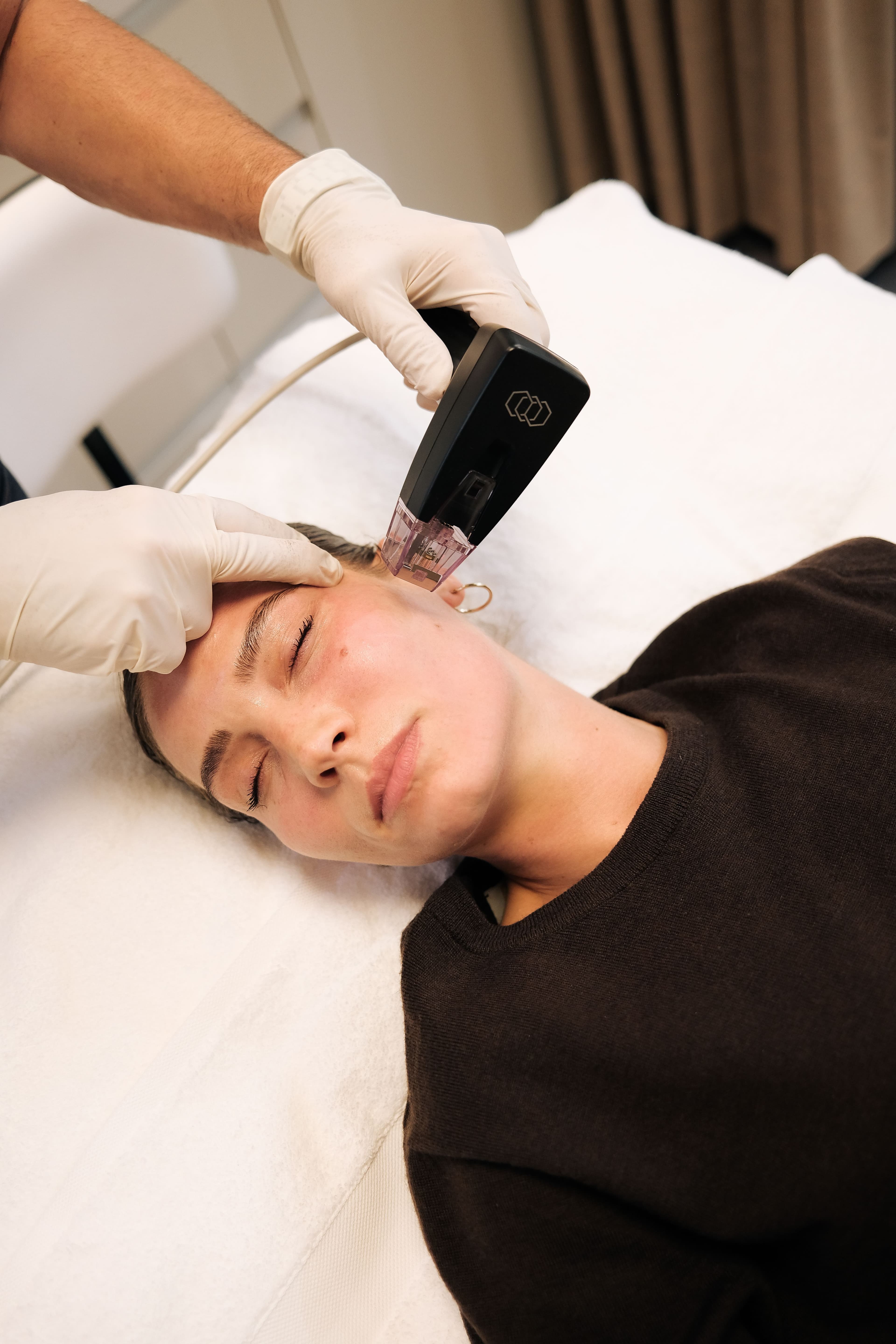 Morpheus8 im Gesicht: Hautverjüngung und Straffung