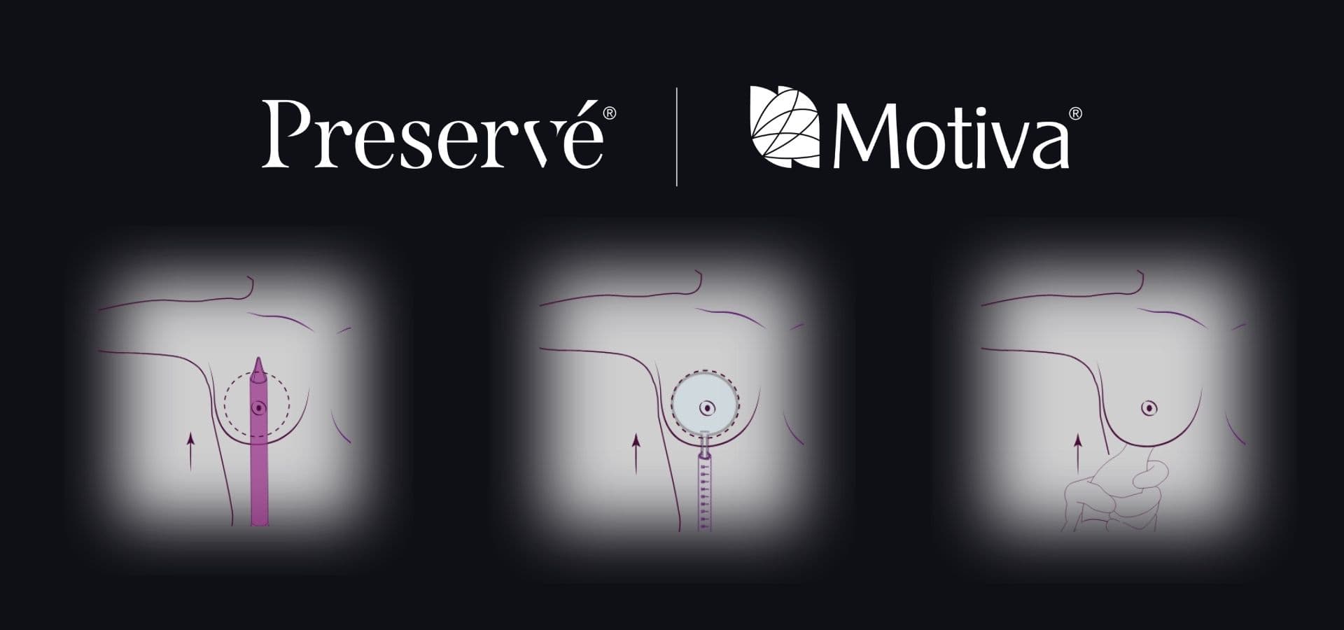 Motiva Preserve Infografik mit drei Behandlungsschritten, Erklärung des Implantatsystems