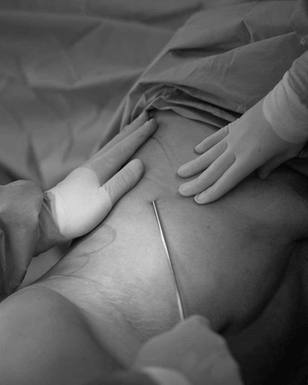 Schwarzweissaufnahme chirurgischer Eingriff, Liposuktion am bein