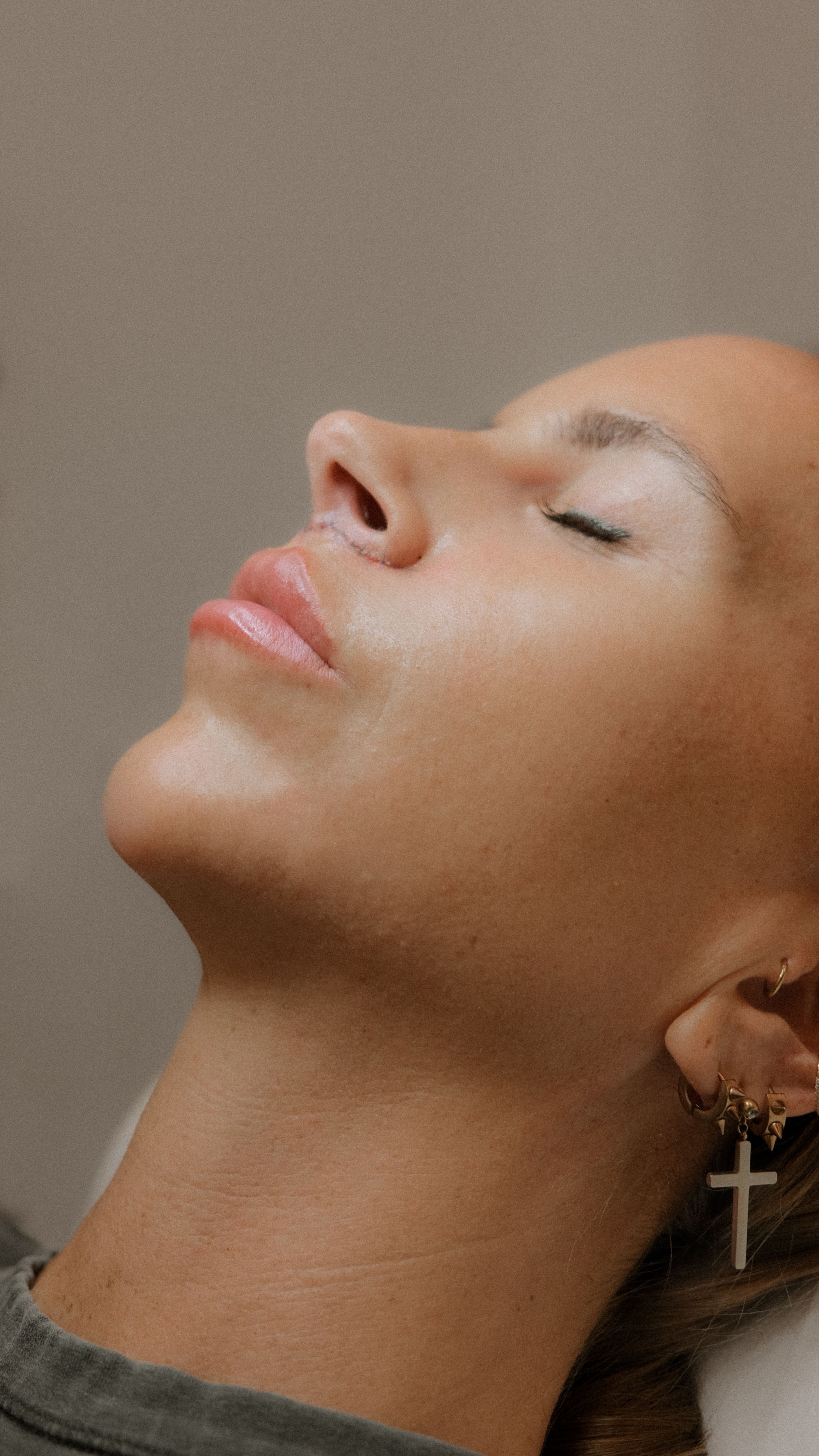 What is a Liplift? or Bullhorn Liplift